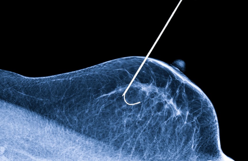La cryoablation est une thérapie prometteuse pour le cancer du sein à un stade précoce