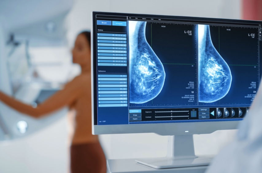 La tomosynthèse représente des économies de 400 millions de reais pour les plans de santé en 5 ans