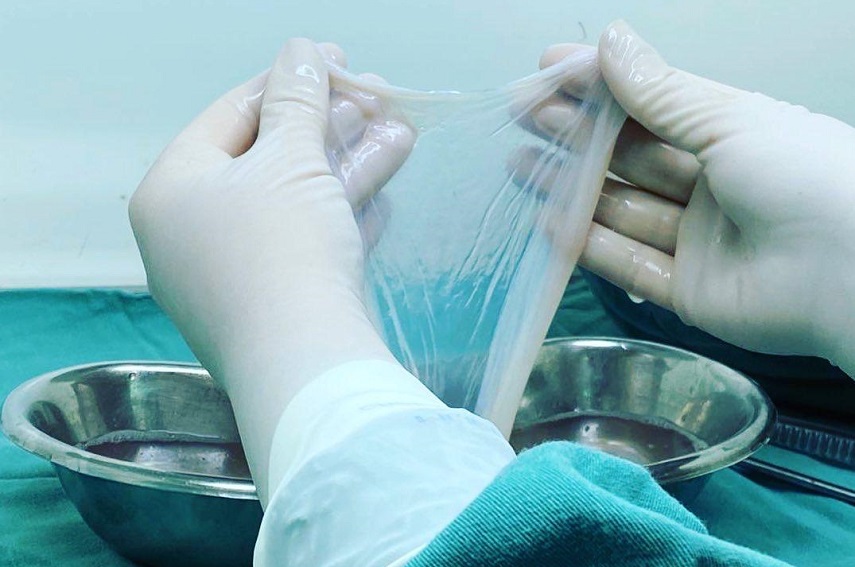 La membrane amniotique est approuvée pour le traitement des brûlés par le SU