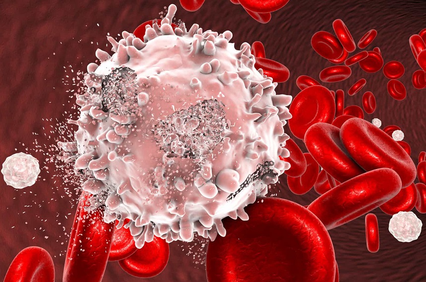 Des recherches sans précédent révèlent l'impact de la leucémie lymphocytaire chronique au Brésil