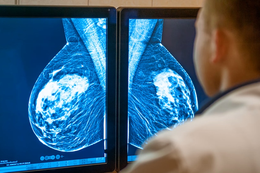 Cancer du sein : une nouvelle technique moléculaire détecte la maladie de manière précoce