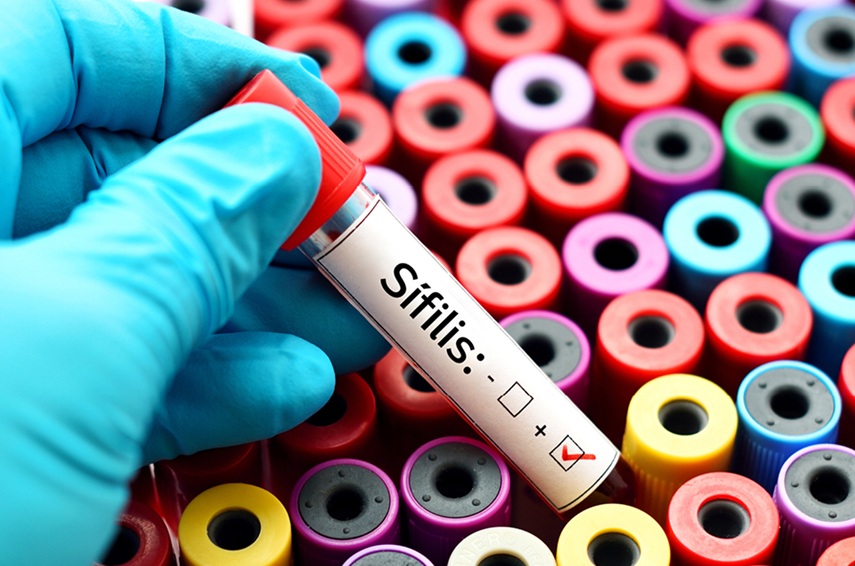 La syphilis continue de croître rapidement au Brésil