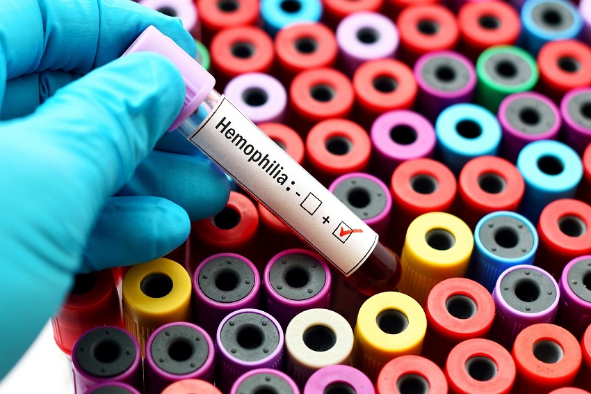 HU-Univasf diagnostique un cas rare d'hémophilie acquise
