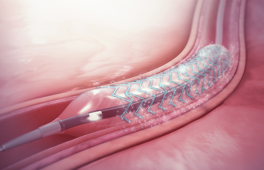 La plus grande étude au monde sur les stents chez les diabétiques réaffirme l'efficacité du traitement standard actuel
