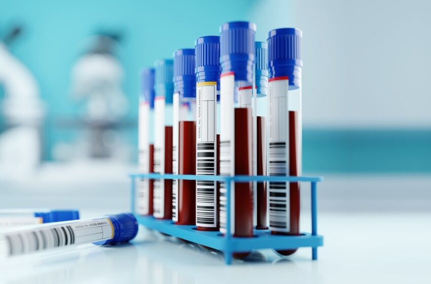 Un test sanguin montre un potentiel pour détecter le cancer des testicules – Medicina S/A