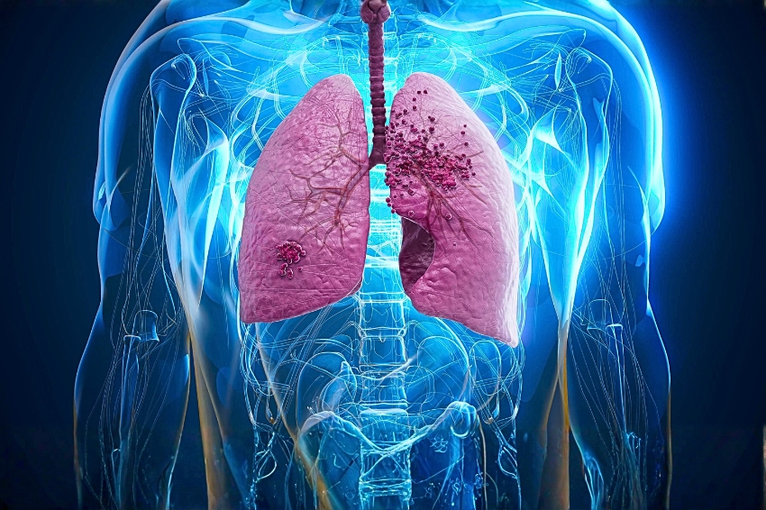 87,64 % des patients atteints d'un cancer du poumon à São Paulo sont diagnostiqués tardivement