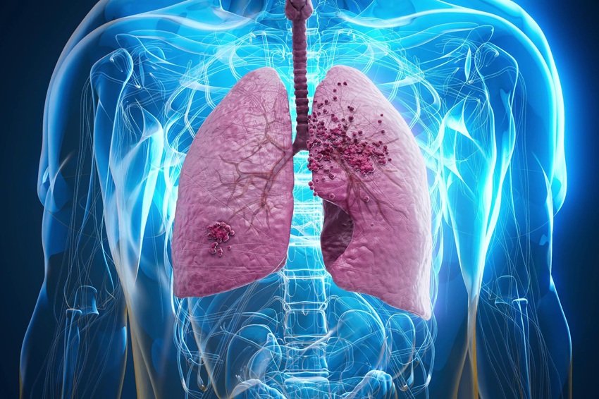 Le cancer du poumon génère 885 millions de reais en coûts hospitaliers en cinq ans